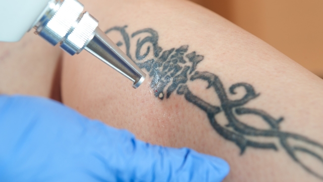 The Very High Cost Tattoo Removal