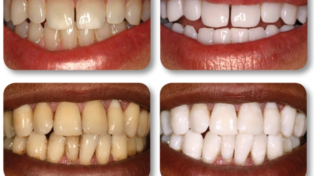 A Brighter Smile: Unveiling the Secrets of Teeth Whitening