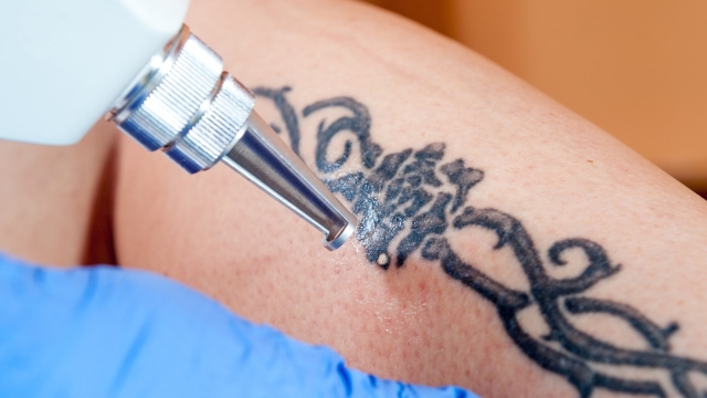 Gang Tattoo Removal – Very Essential