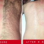 Smooth Sailing: The Ultimate Guide to Laser Hair Removal