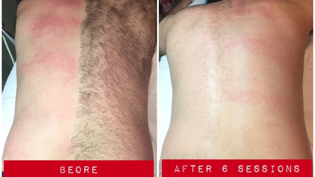 Smooth Sailing: The Ultimate Guide to Laser Hair Removal